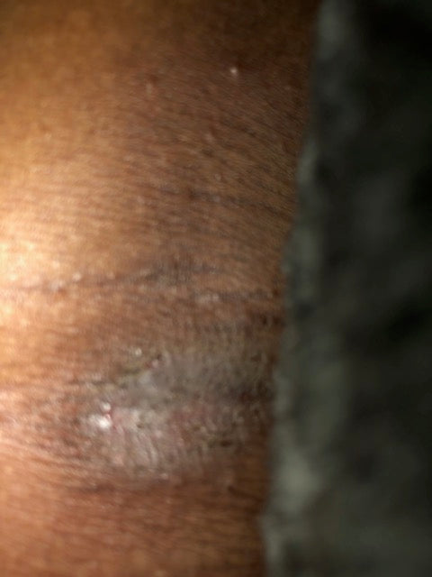 Derma bloom " Body Oil for dry skin conditions eczema " 8 oz